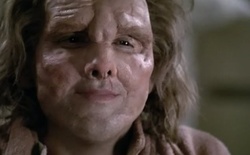 Notre Johnny national après sa chirurgie